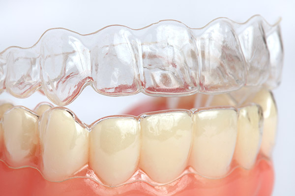 Are You A Candidate For Wearing Clear Aligners?