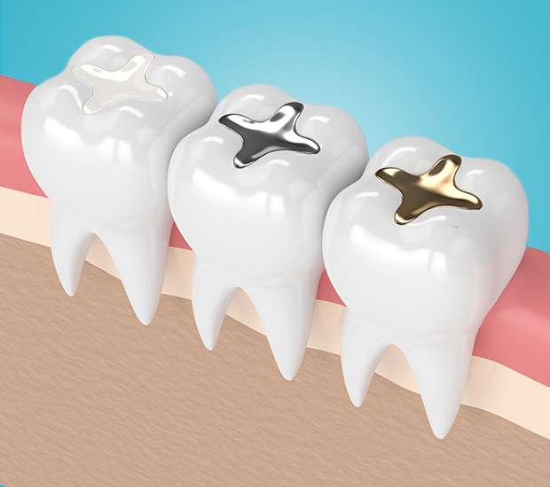 Stuart Tooth Colored Fillings