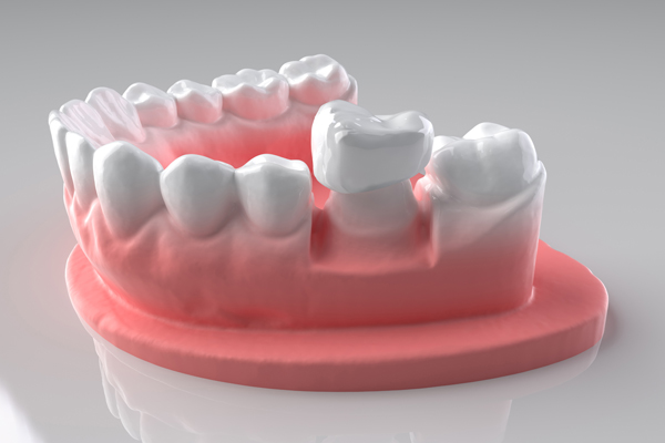 Dental Crown Used To Attach A Dental Bridge