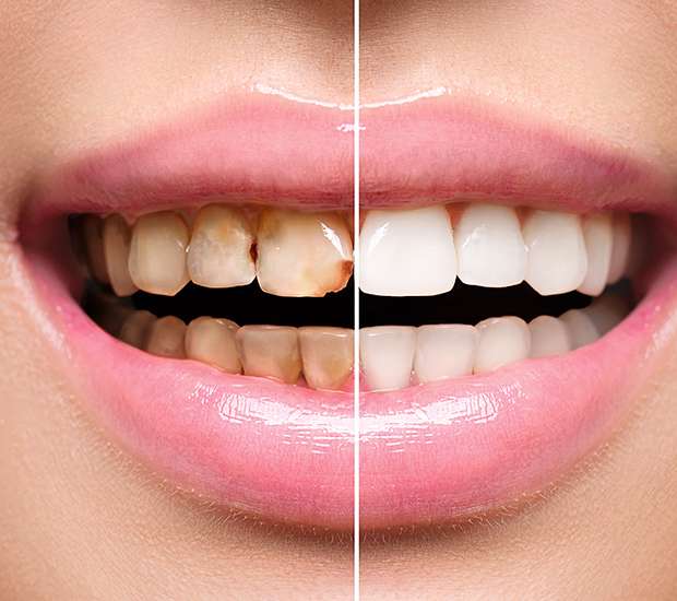 Stuart Dental Implant Restoration