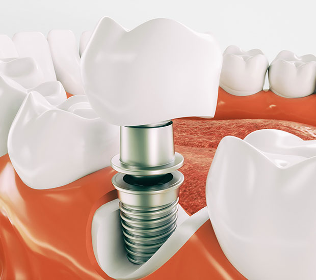 Stuart Dental Implant Restoration