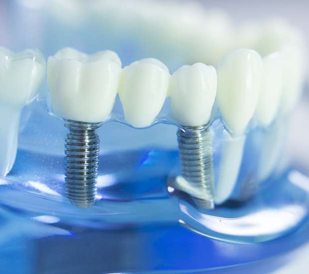 Stuart Dental Implants