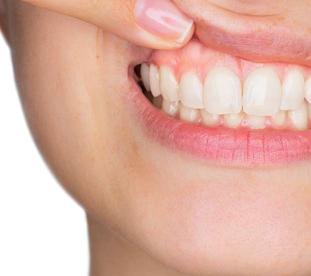 Stuart Gum Disease