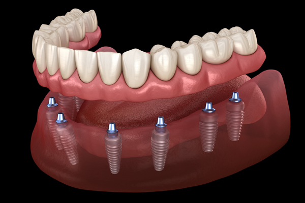 Caring For The Gums Under Implant Supported Dentures