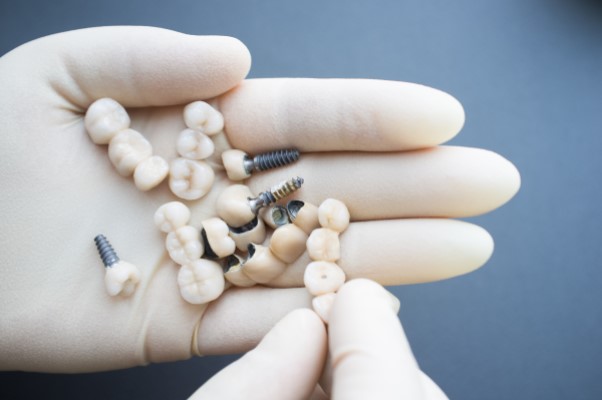 How Many Teeth Can Be Replaced With Multiple Tooth Implants?