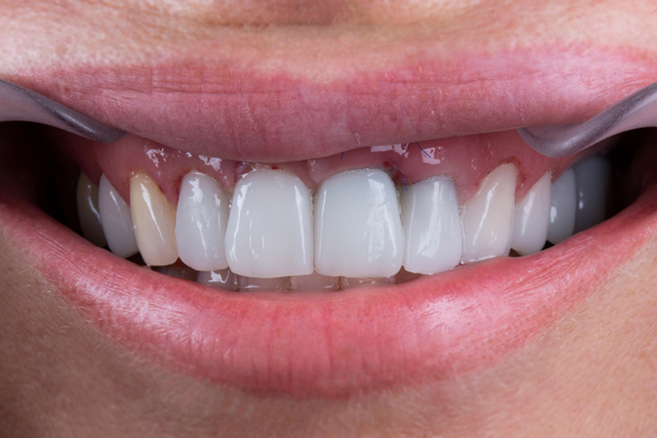 Partial Denture Options