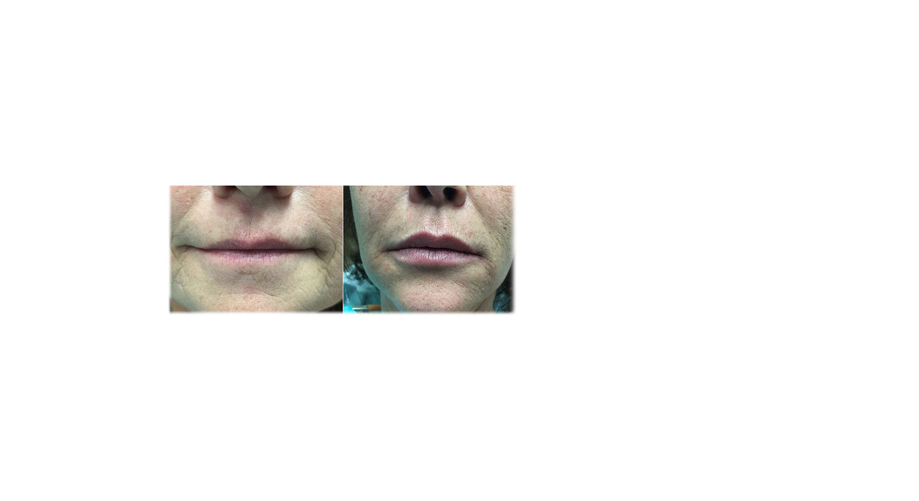 With Juvederm®, Dr DeLucia can give you fuller lips